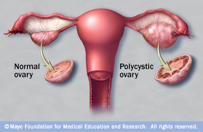 mcdc7_polycystic_ovary